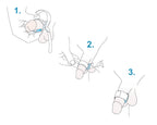 Medintim Prosecca® Band – Ansicht 4